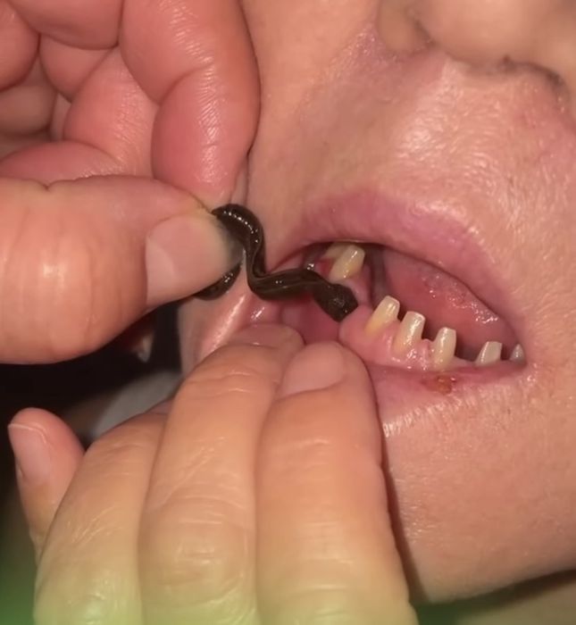 Лечение  Пиявками Гирудотерапия