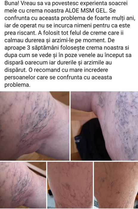 Crema de varice de la forever