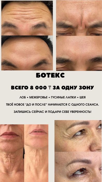 Ботокс!Устранение морщин ботоксом,3-4зон,устранение заломом межбровных