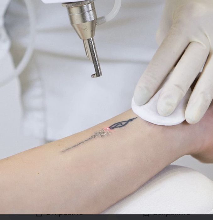 Удаление тату, папиллом, растушёвки, веснушек, массаж лица