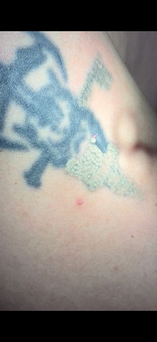 Laser stergere tatuaje