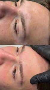 Vitiligo kamuflyaji