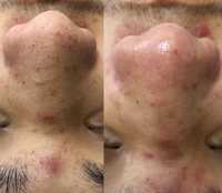 Чистка лица для мужчин и женшин , лечение гипергидроз