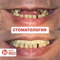Стоматология протезы. Протезирование зубов. Коронки. Металакерамика