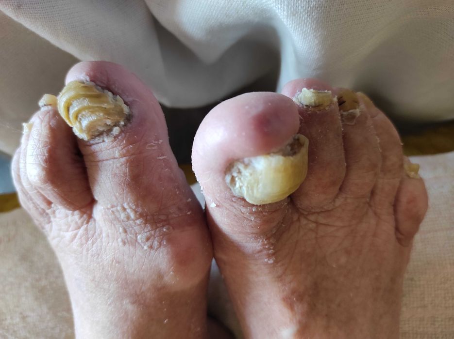 Медицински педикюр по домовете