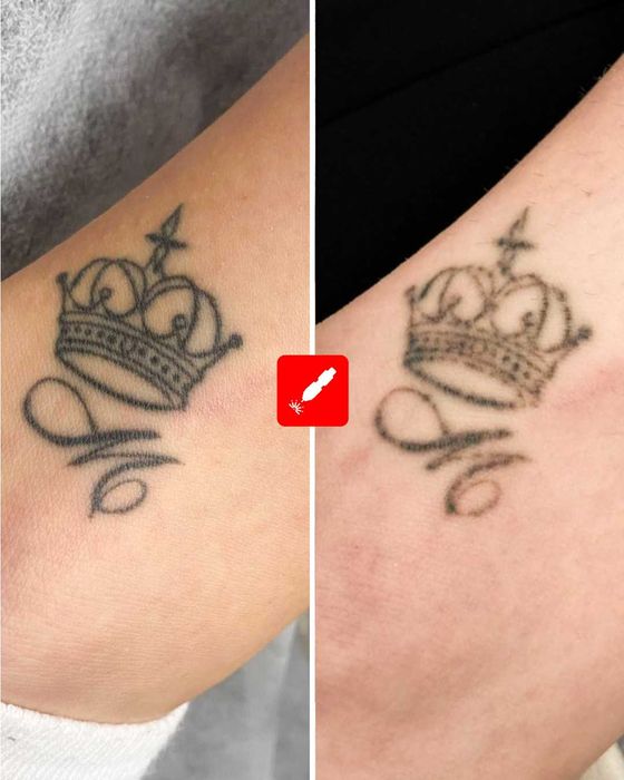 Лазерно Премахване на Татуировки