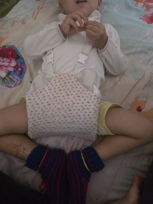 Шина Фрейка для лечения дисплазии