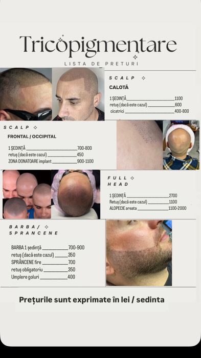 Micropigmentare scalp tricopigmentare efect indesire par alopecie