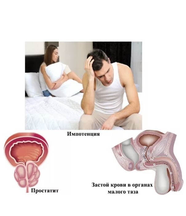 Урологиялық массаж (простат массажы)