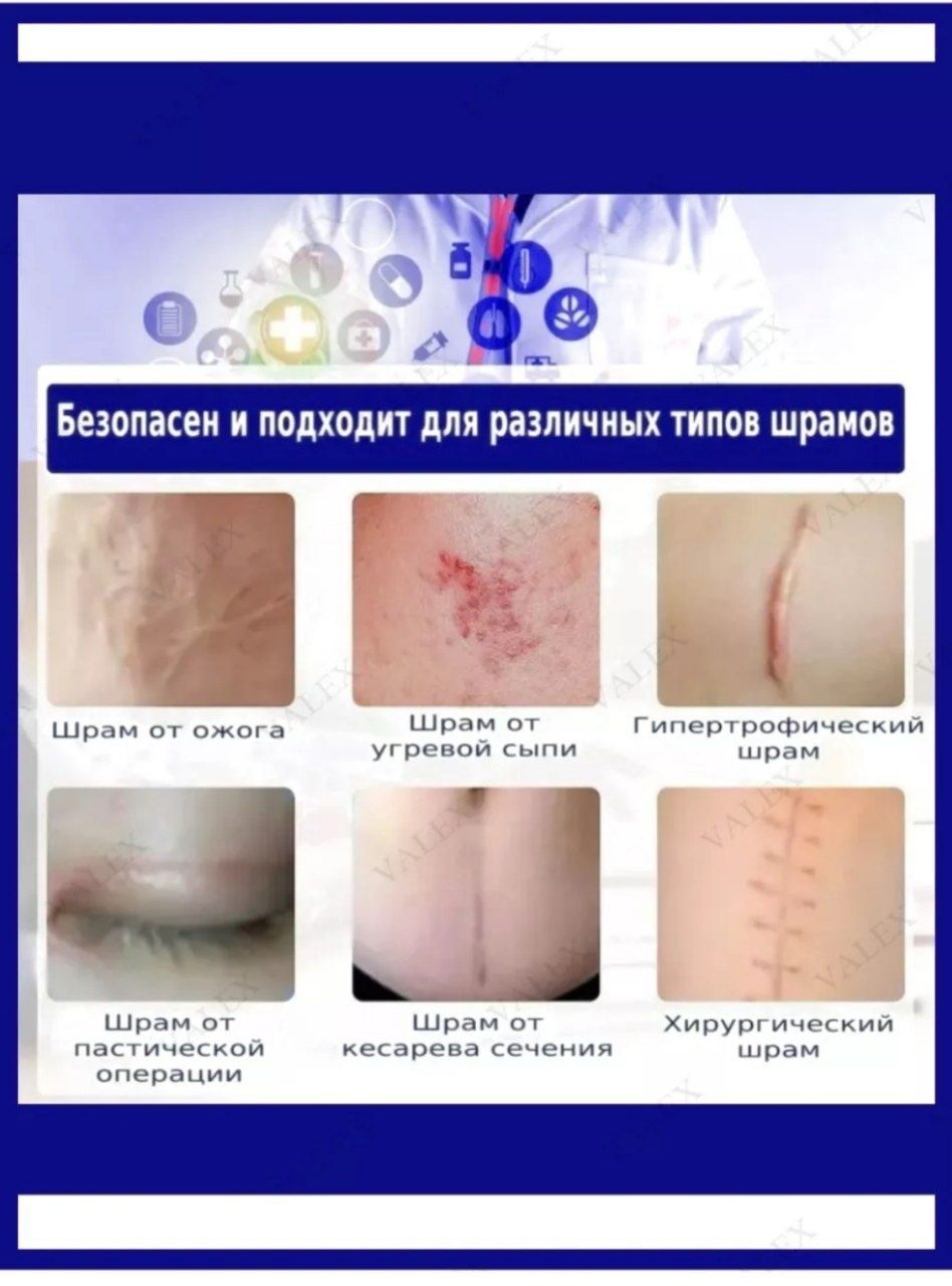 Продам силиконовый пластырь от рубцов