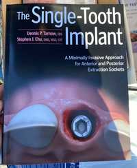 The Single-Tooth Implant J.Chu