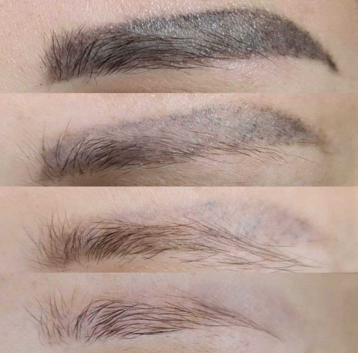 Удаление Татуажа любого цвета РЕмувер+лазер 5тыстг