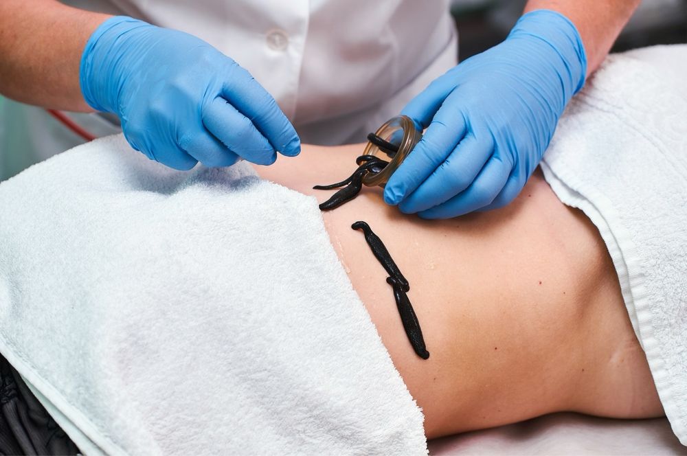 Гирудотерапия Сулик салу үйге барып пиявки выезд Апитерапия