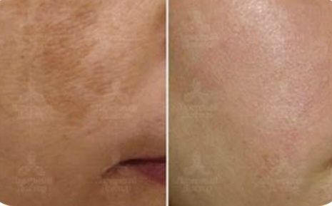 YUZDAGJ DOGLARni ketqazish, meza, biorevitalizatsiya. Отбеливание, уда