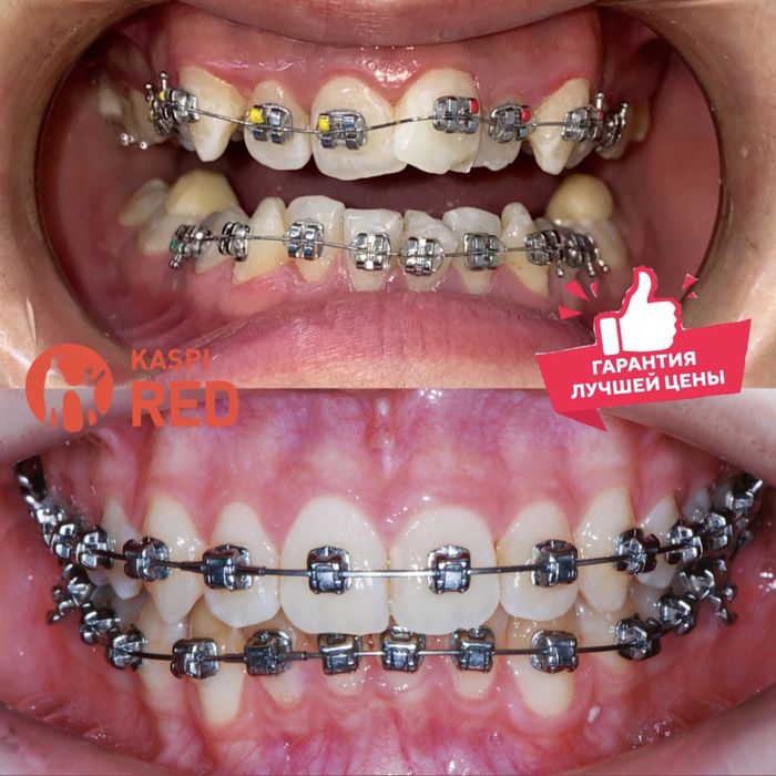 Брекеты! Американские самолигирующие  брекетов !