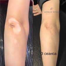 Vitiligo kamuflyaji