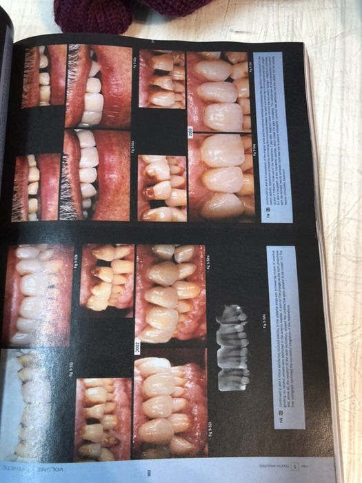 Esthetic Rehabilitation in Fixed Prosthodontics, Volume 1 & 2 FRADEANI
