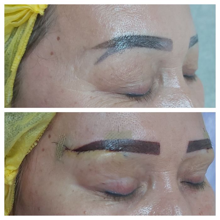 Лабиопластика,Броулифтинг,Блефаропластика.