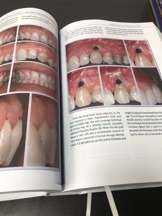 Mucogingival Esthetic Surgery - Giovanni Zucchelli