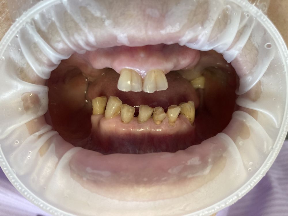 Стоматолог протезы   Протезирование зубов