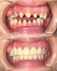 Диоксид циркония коронки зубные