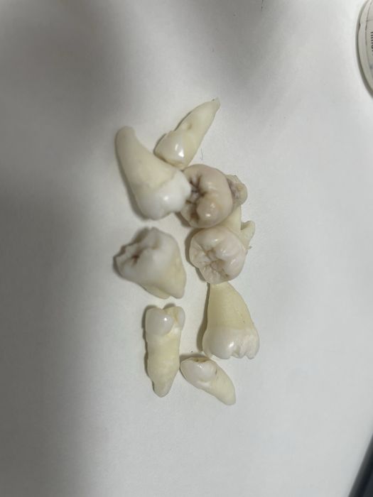 Зубы,зуб мудрости