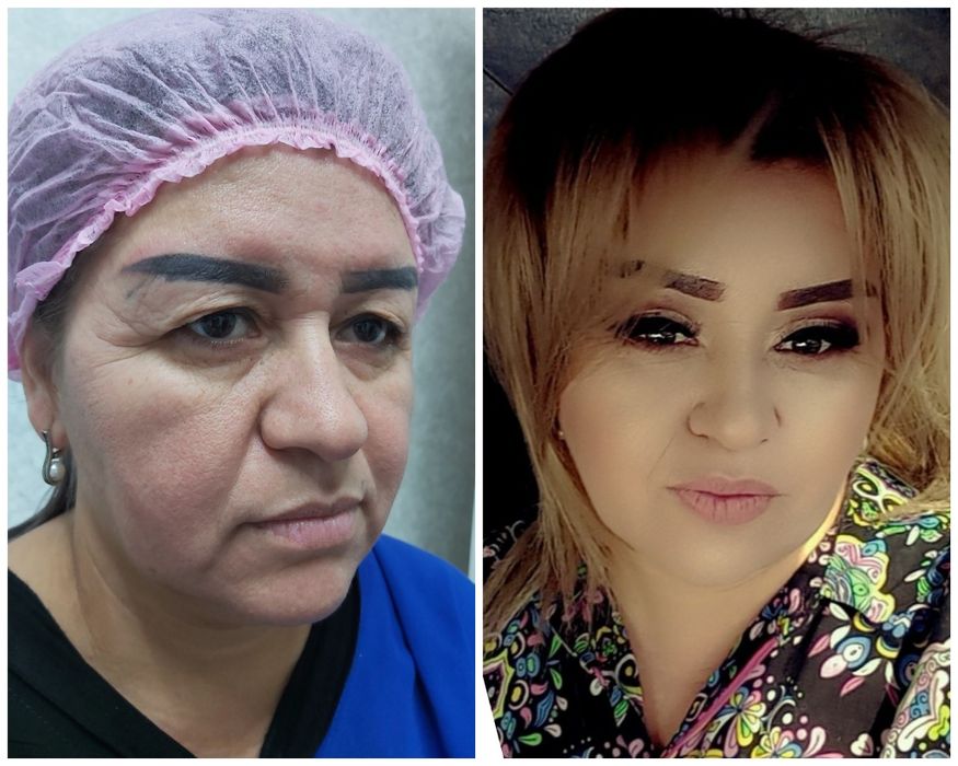 Лабиопластика,Броулифтинг,Блефаропластика.