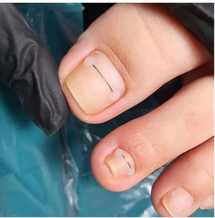 Услуги подолога титановая нить