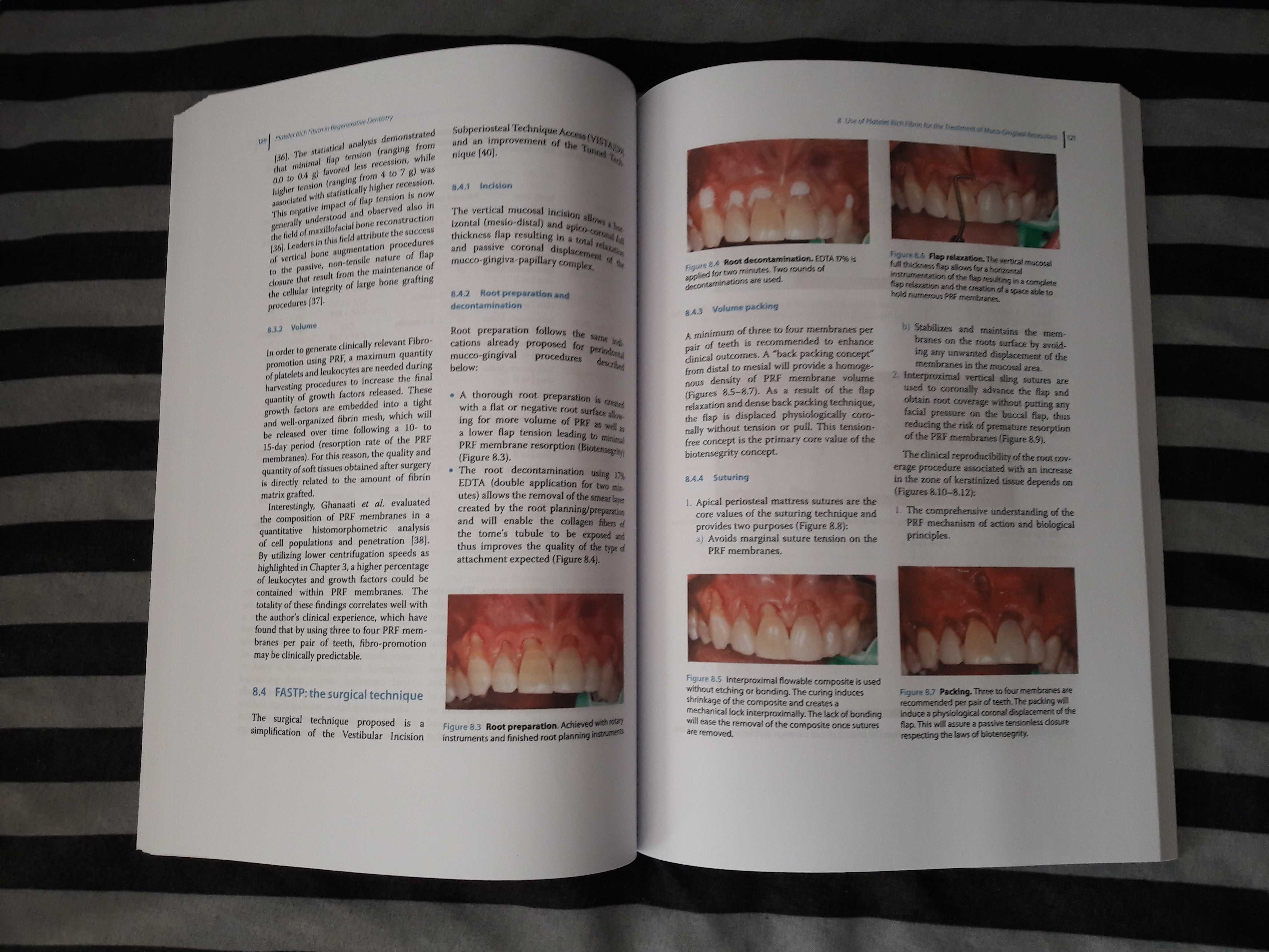 Platelet Rich Fibrin in Regenerative Dentistry 2017