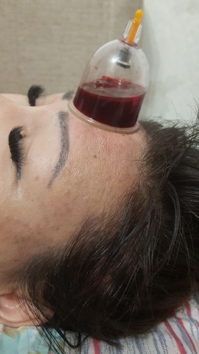Хиджама от давления 30 лет стажа. Пиявки, массажи, психотерапия Медобр