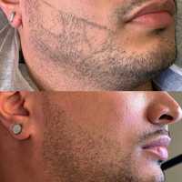 Micropigmentare barba, scalp, sprancene barbati