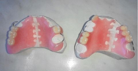 Починка протезов