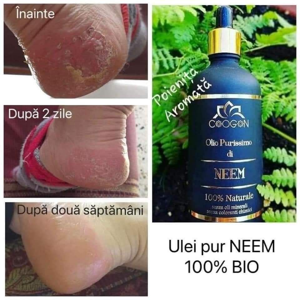 Ulei de Neem Chogan anti bacterian anti fungic vergeturi psoriazis