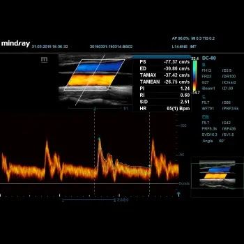 УЗИ Апарат Mindray DC-60 X-insight