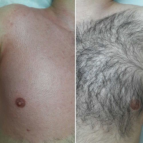 Депиляция для мужчин и женщин