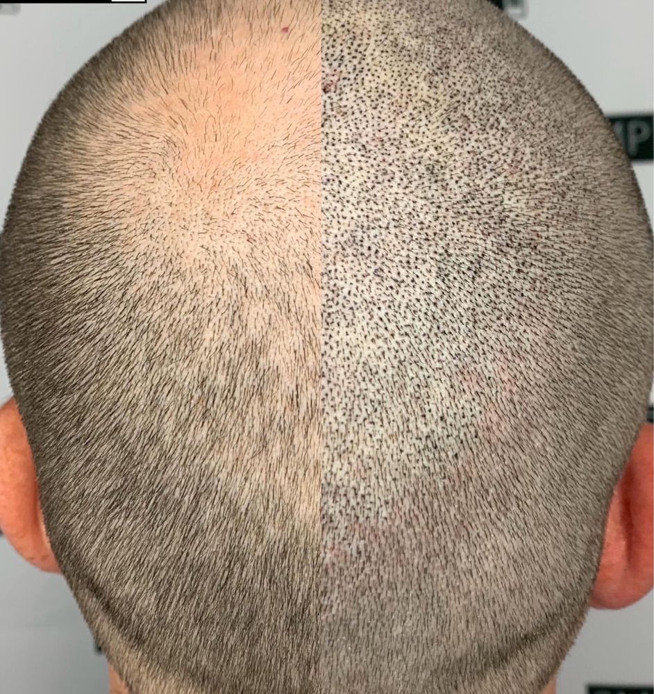 Micropigmentare scalp tricopigmentare efect indesire par alopecie