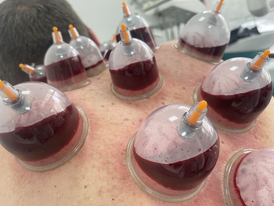 Хиджама! Врач с большим опытом работы!