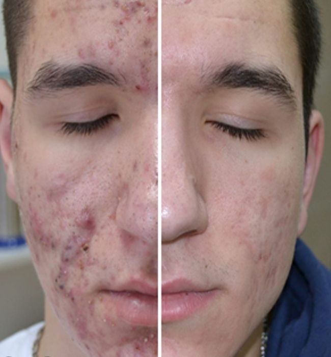 Угри,акне.прыши личение.