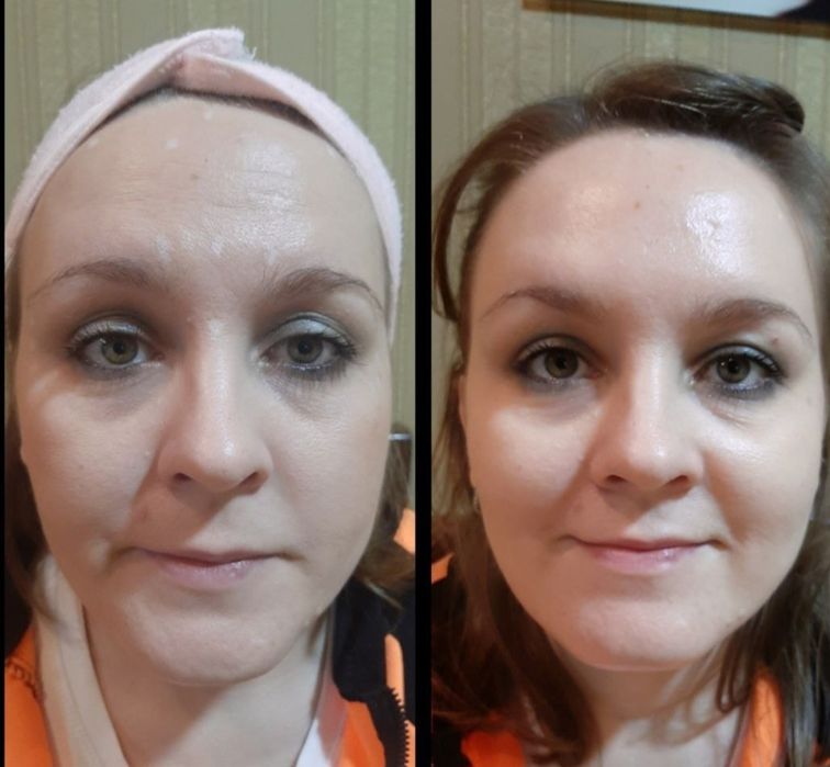 Ботокс. Лоб, межбровка,глаза.  Шея, овал лица