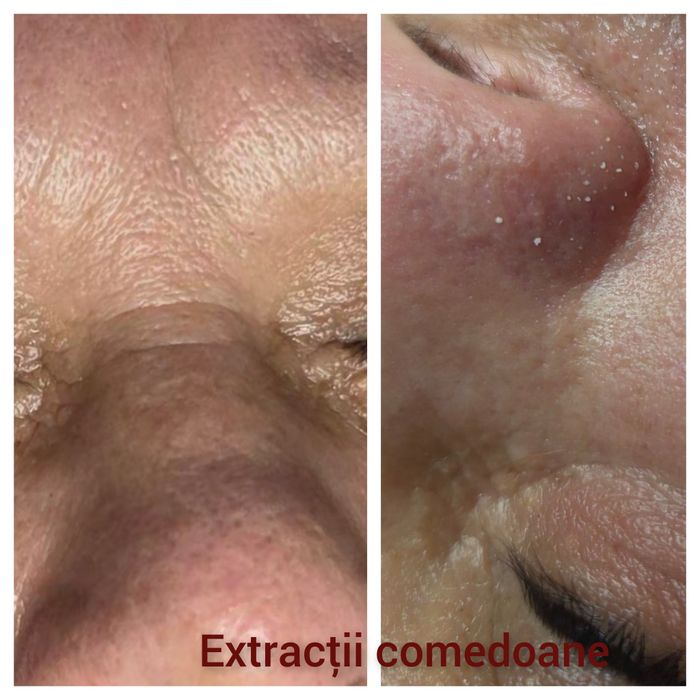 Tratament facial de curățare