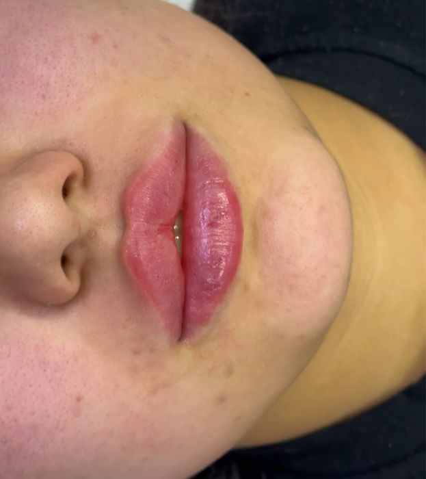 УВЕЛИЧЕНИЕ губ косметолог