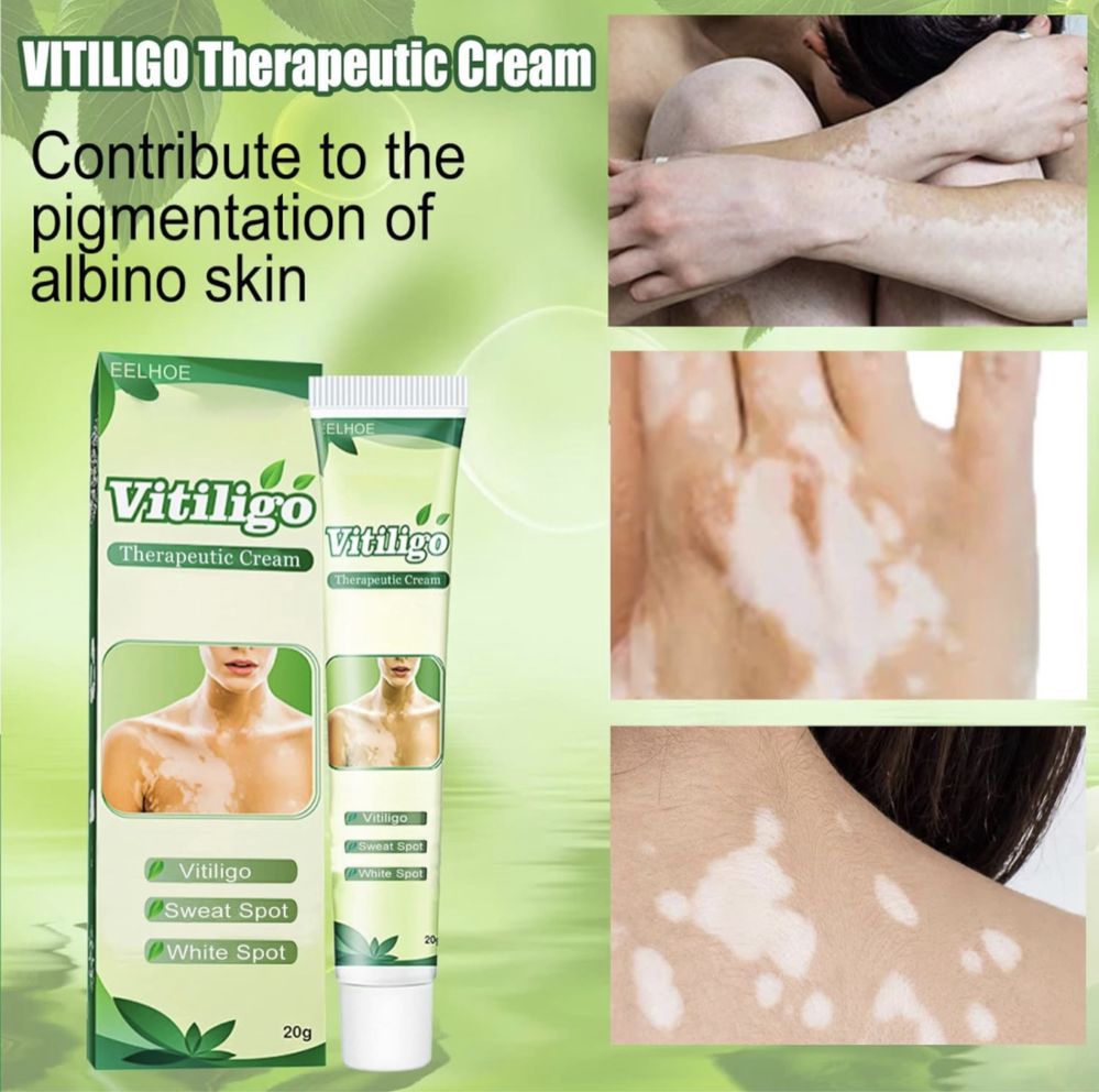 Vitiligo (Oq dog’lar)