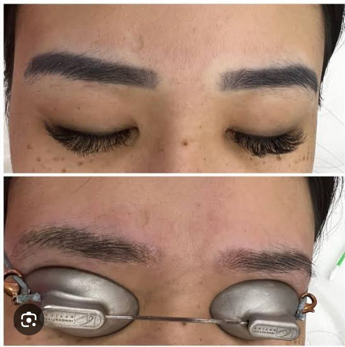 Удаление татуажа бровей.Татуаж учириш.