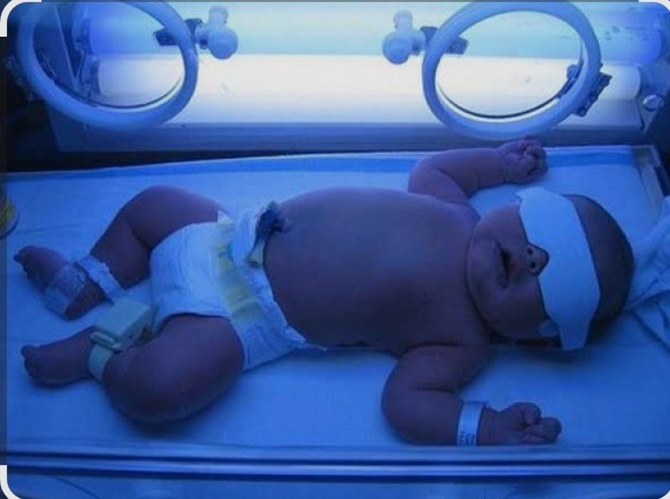 Fotolampa, uy sharoitida sariqlikni davolaymiz