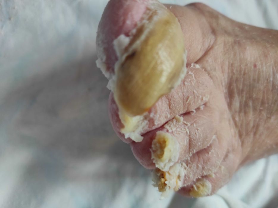 Медицински педикюр по домовете