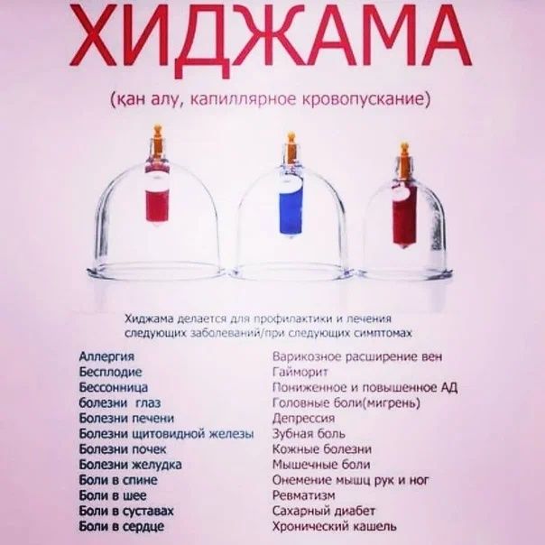 Хиджама. Қан алу тәжірибелі маман.