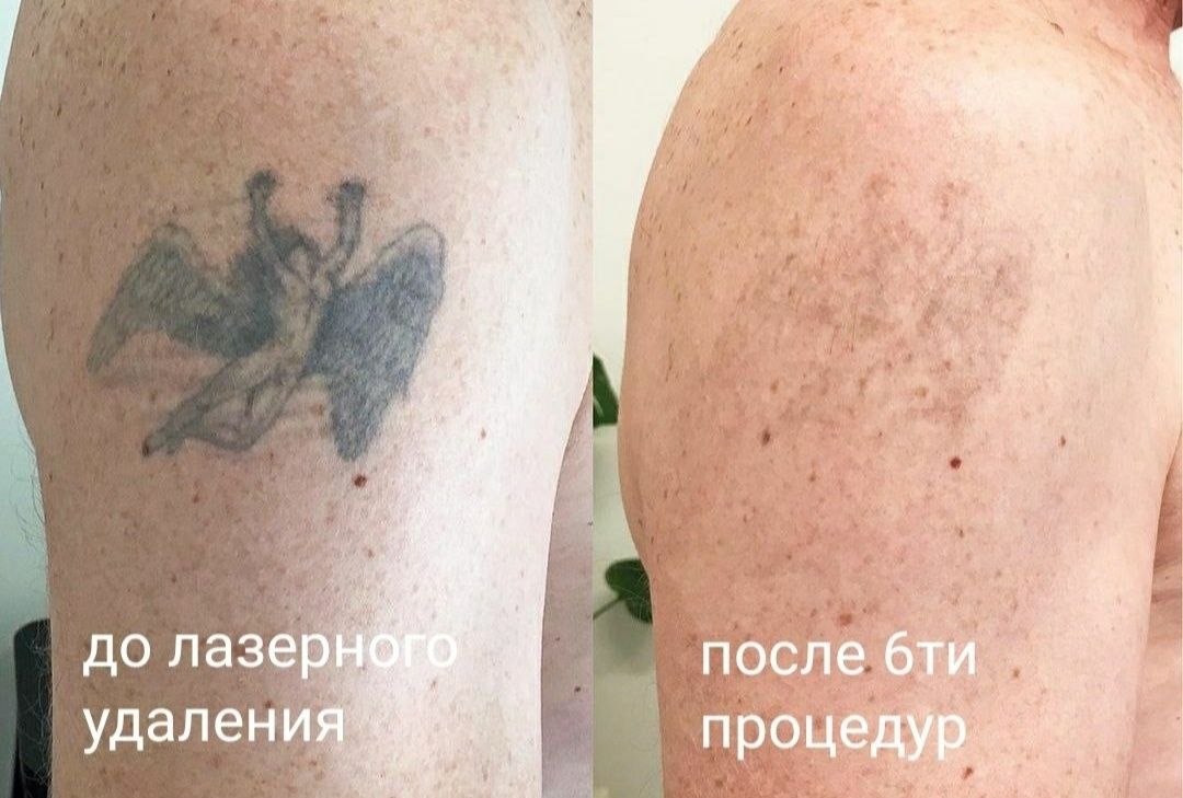 Удаление татуажа татуировки ремувер лазер брови губы стрелки
