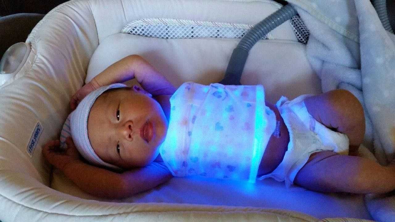Fotolampa uy sharoitidachaqaloqlardagi Sariqni davolash