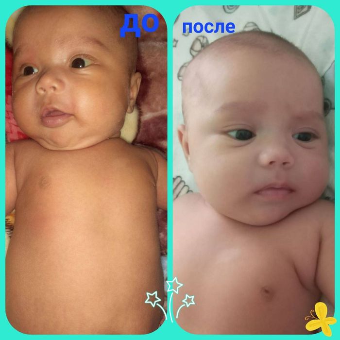 Фотолампа, билирубинни туширишда тез ва ишончли ёрдам.