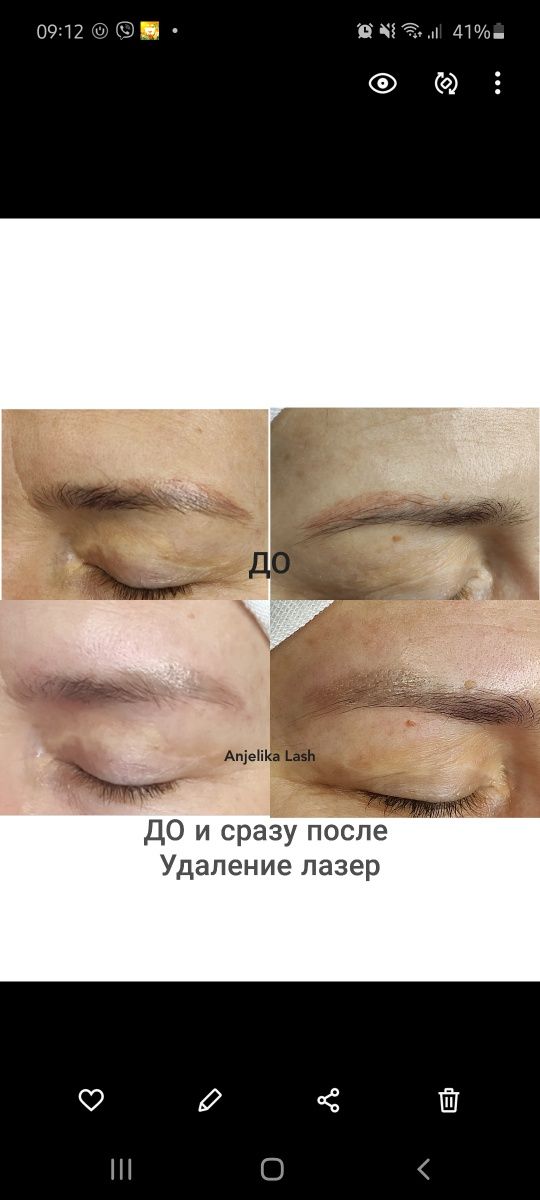 Удаление татуажа и тату неодимовым лазером .Ориентир остановка Электро